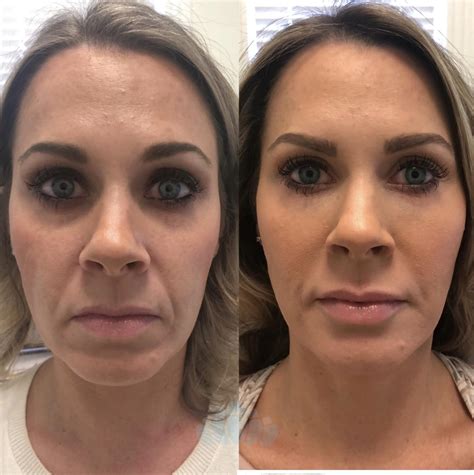 botox fillers charlotte nc.